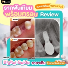 รากฟันเทียม 36900 บาท รวมครอบฟันเซรามิกแบบแพงแล้วด้วย