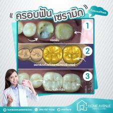 ครอบฟันเซรามิกสีเหมือนฟันระบบดิจิตัล 15000 บาท